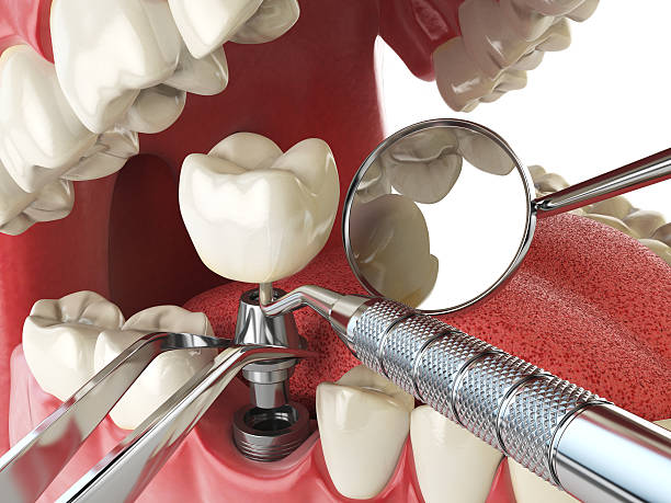 Best Emergency Dental Care for Broken or Chipped Teeth in Dundee, OR